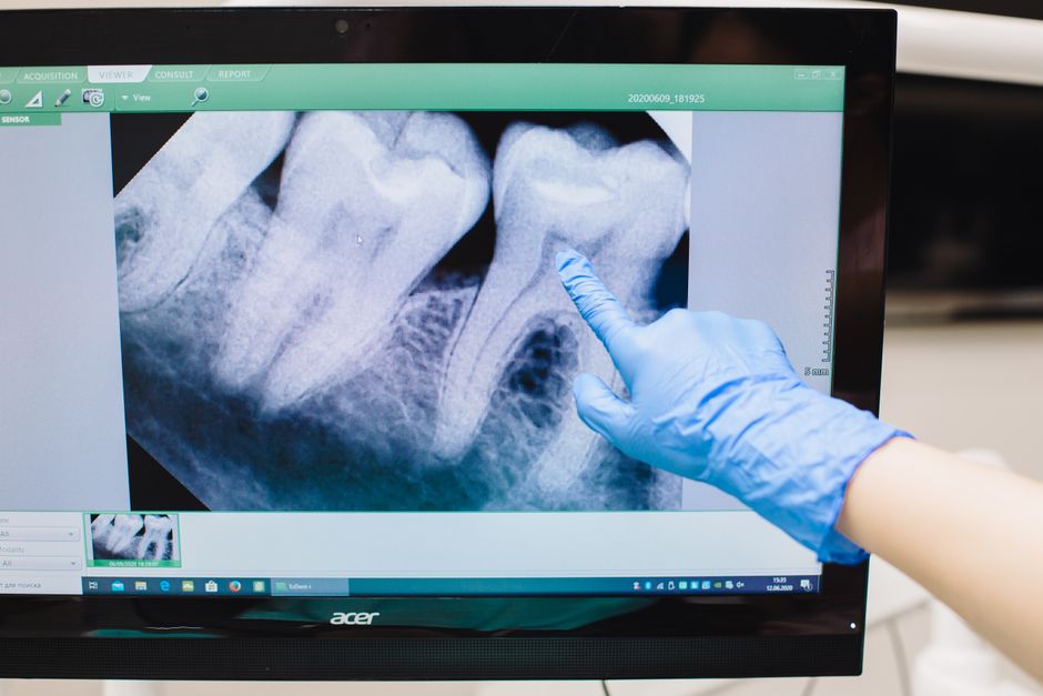 Dentist reviewing digital dental scan for porcelain veneer planning